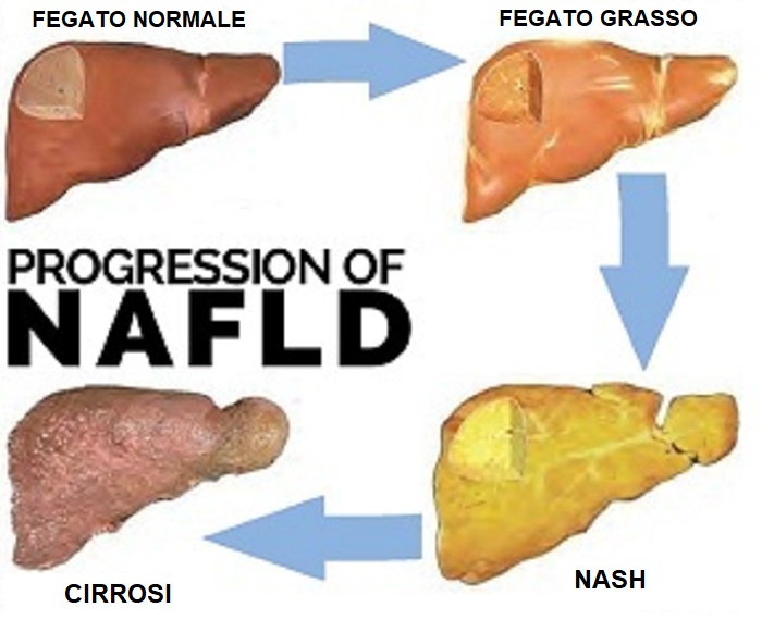 FEGATO GRASSO