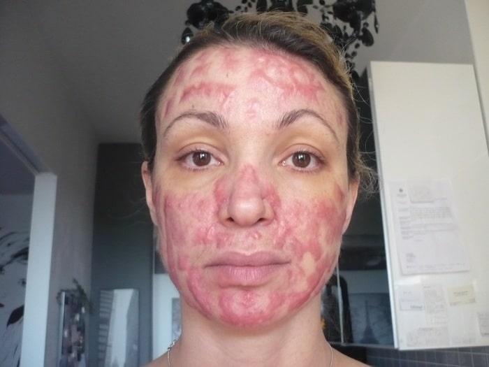 Cristina Guidetti, ex modella sfigurata dal chirurgo: "93mila euro buttati, non uno di risarcimento"