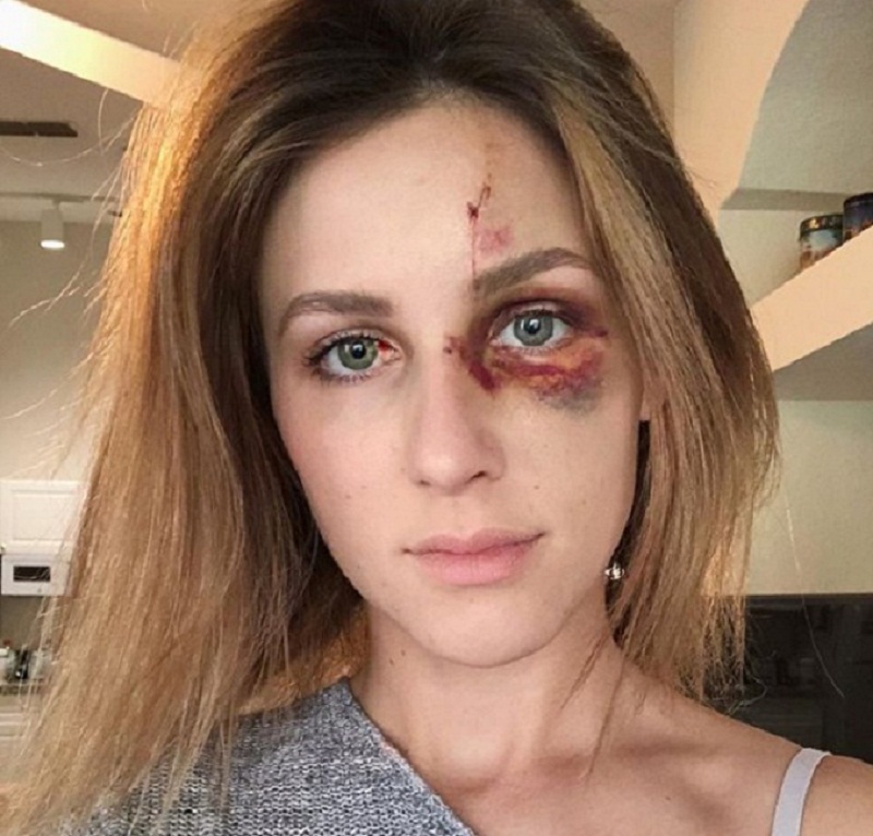 Melissa Gentz picchiata e quasi strangolata dal fidanzato geloso: "Sei troppo scollata in quella foto"