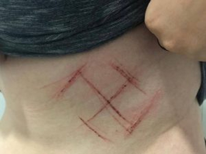 Brasile, 19enne picchiata e insultata in strada: le incidono una svastica sulla pelle