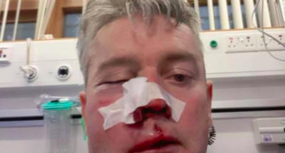 Da San Basilio all'Irlanda, ancora violenza sugli arbitri: mascella rotta a Sweeney dopo aggressione