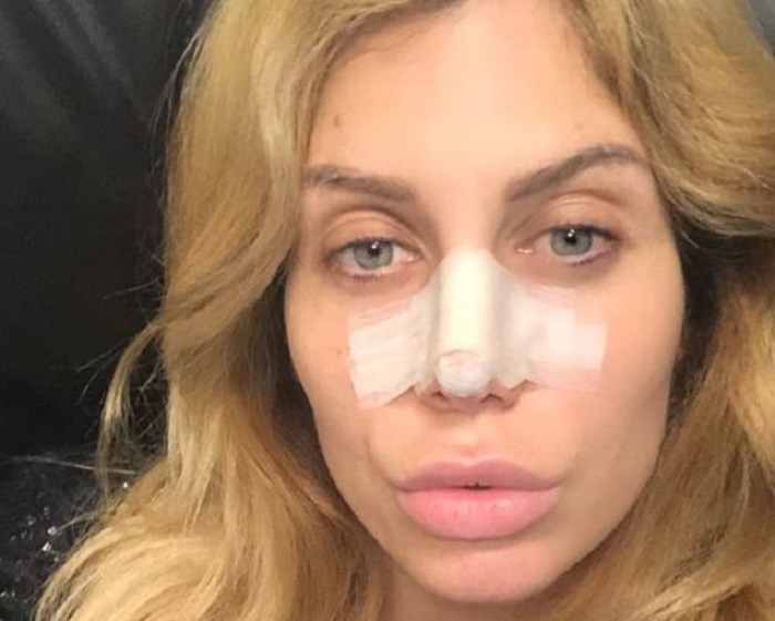 Paola Caruso operata al naso dopo una botta a Pechino Express