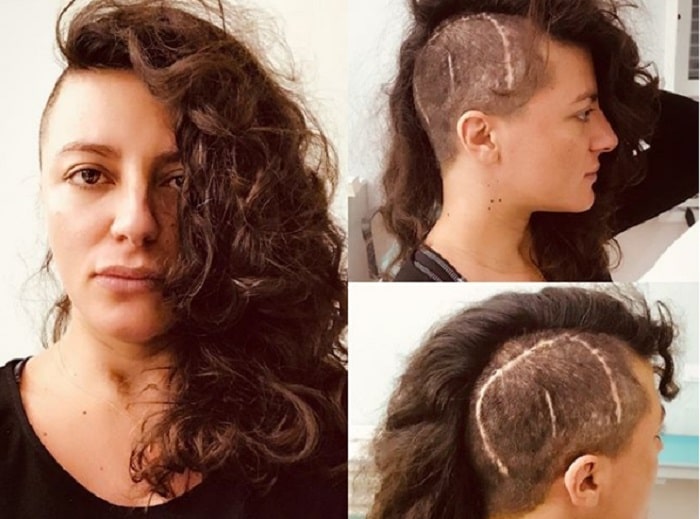 Clio Evans, moglie di Lele Spedicato, mostra la cicatrice in testa FOTO Instagram