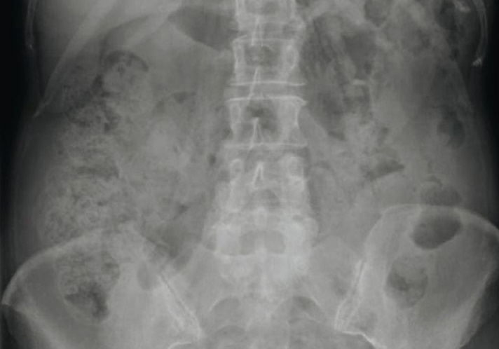 dolori stomaco chiodi