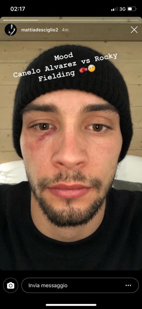 Foto, De Sciglio con l'occhio nero dopo il derby: l'immagine è virale sui social