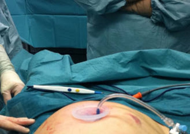 Brasile: prima bambina nata dopo trapianto di utero da donatrice deceduta