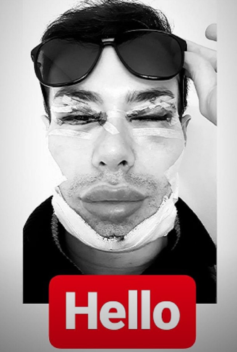 Angelo Sanzio, il "Ken Umano" è irriconoscibile dopo l'ultima operazione (foto Instagram)