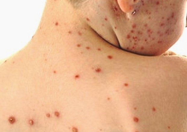 Morbillo, allarme Unicef: "Casi in aumento in tutto il mondo. Colpa dei no-vax"