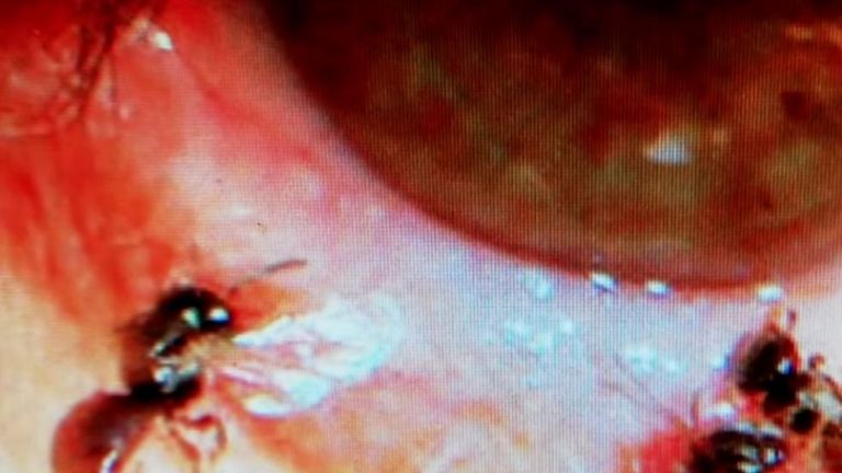 Taiwan: estratte vive dall'occhio di una ragazza quattro api. Si nutrivano delle sue lacrime