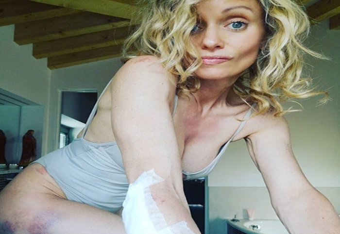 Justin Mattera, brutta caduta in bici con Francesco Moser (foto Instagram)