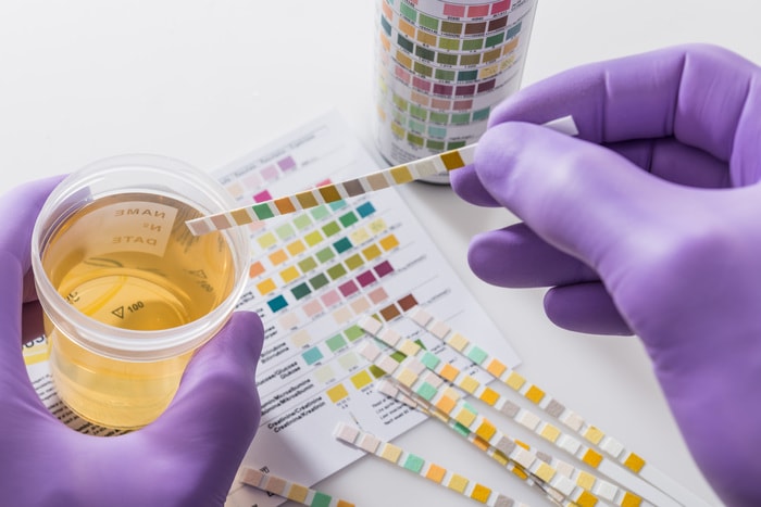 Cancro alla prostata, un nuovo test delle urine per diagnosi e prevenzione