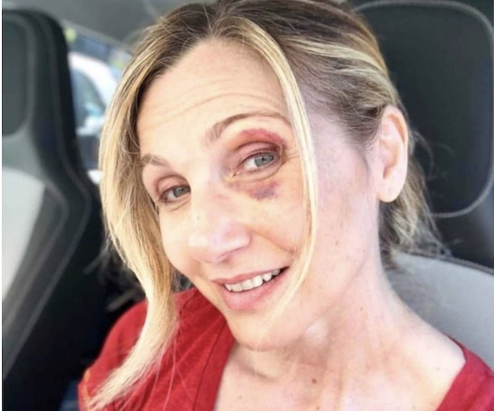 Lorella Cuccarini con un occhio nero. La foto spaventa i fan: "Sono caduta in una buca"