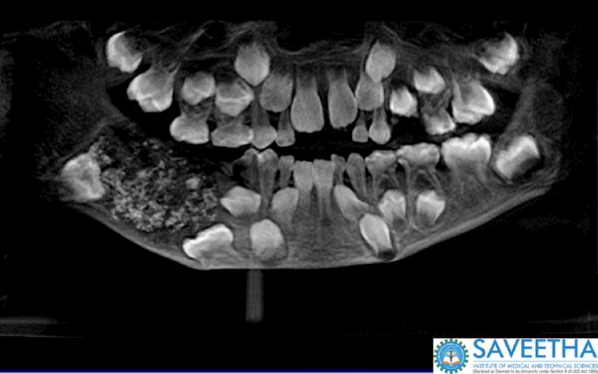 India, estratti 526 denti dalla bocca di un bambino di 7 anni
