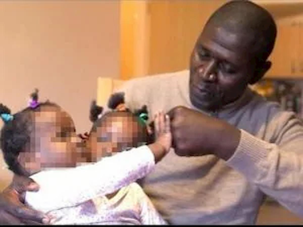 Gemelline siamesi, la scelta impossibile per un papà