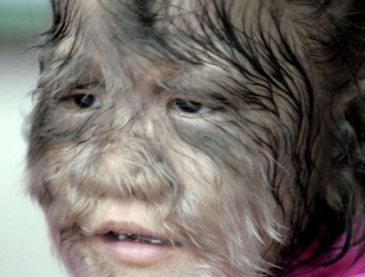 Spagna, 17 bambini con la "sindrome da lupo mannaro". Hanno assunto farmaci contaminati