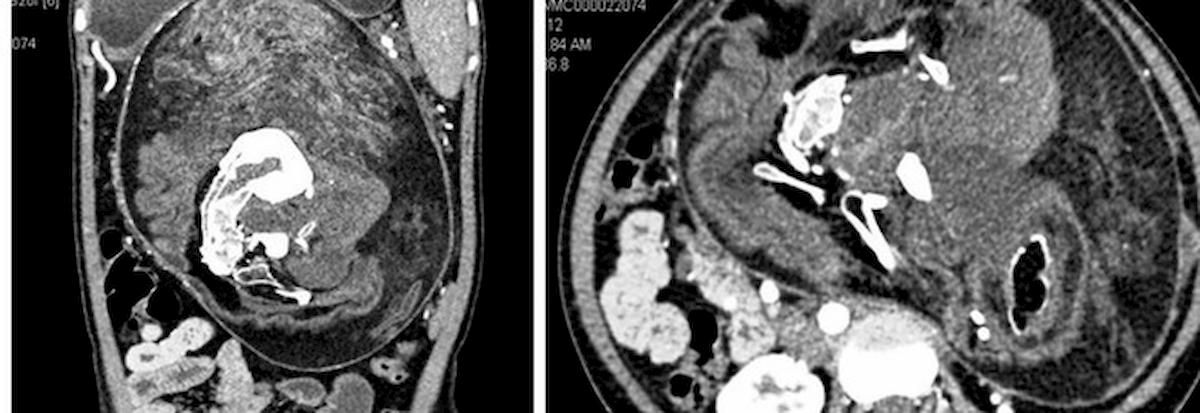 17 anni scopre fratello gemello
