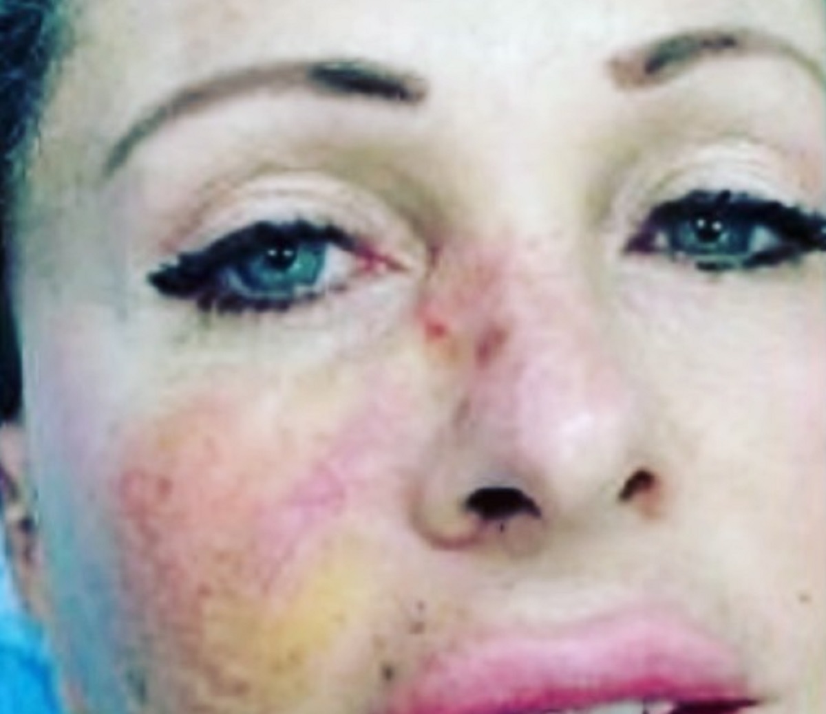 Paola Ferrari e una vecchia foto con un carcinoma al viso