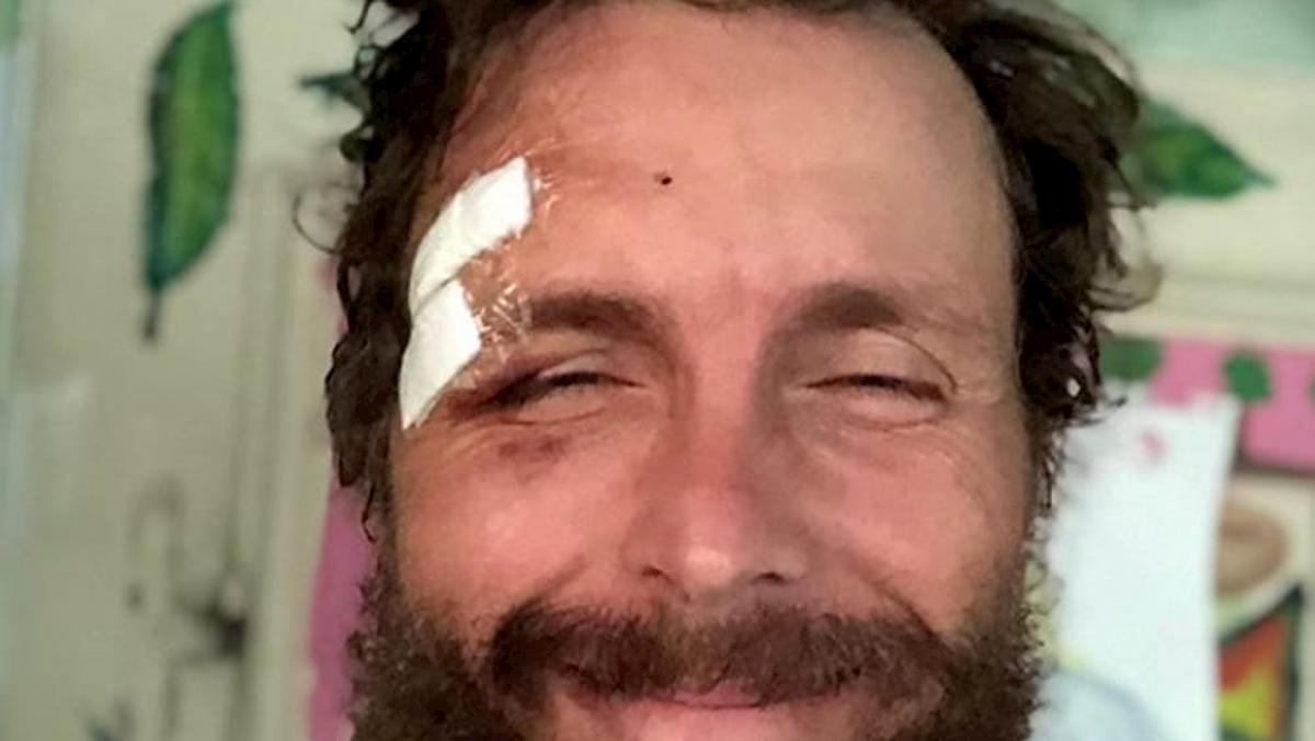 foto jovanotti con cerotto in testa