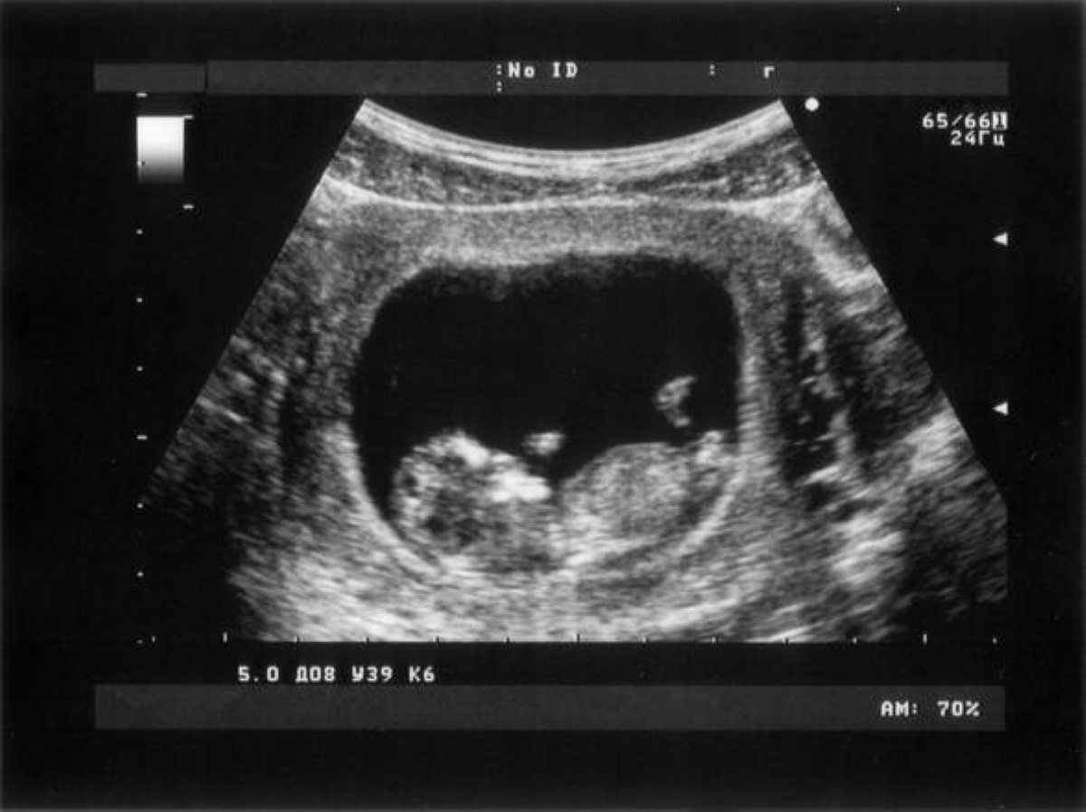 Ecografia senza contatto: la nuova tecnologia laser per neonati e ustionati