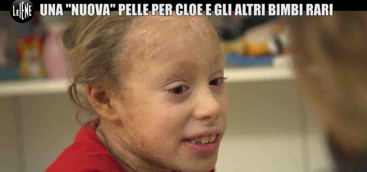 Ittiosi, la malattia rara della pelle. La storia di Cloe: "In inverno rischio l'ipotermia"