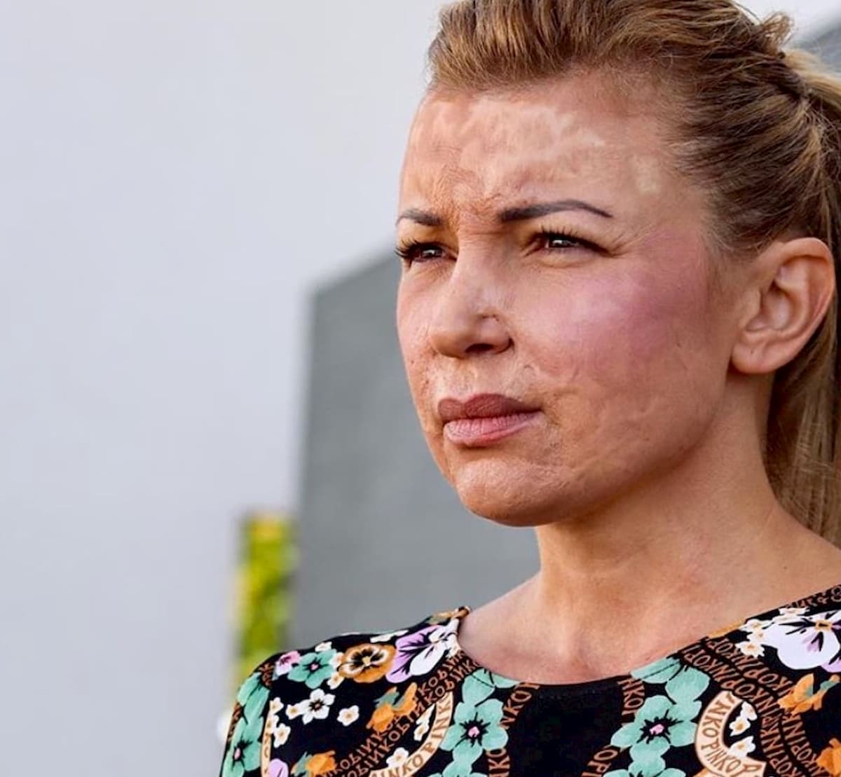 Modena, ex modella sfigurata dopo un intervento sarà risarcita