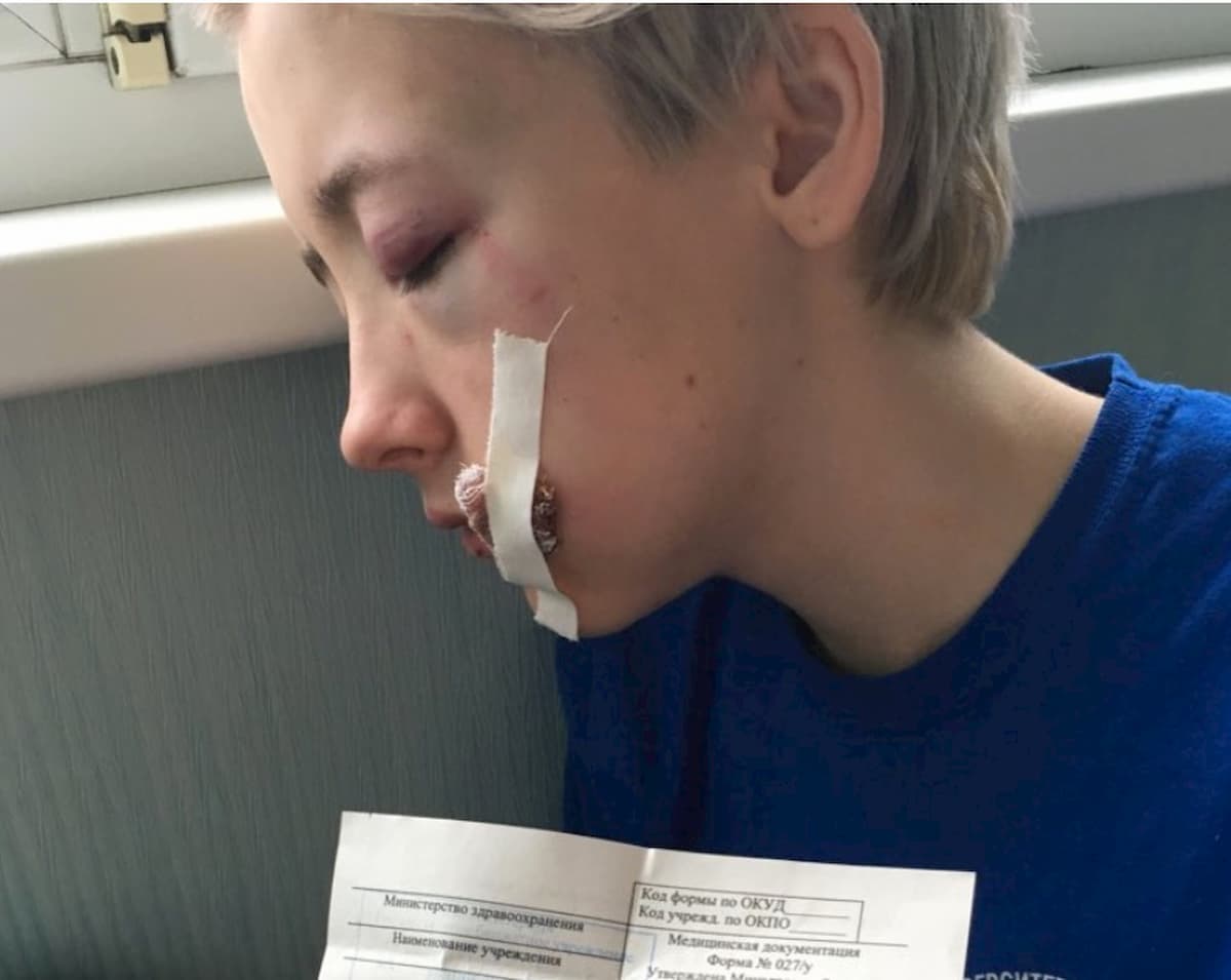 Russia, ragazza aggredita a San Pietroburgo: "Sembrava lesbica"