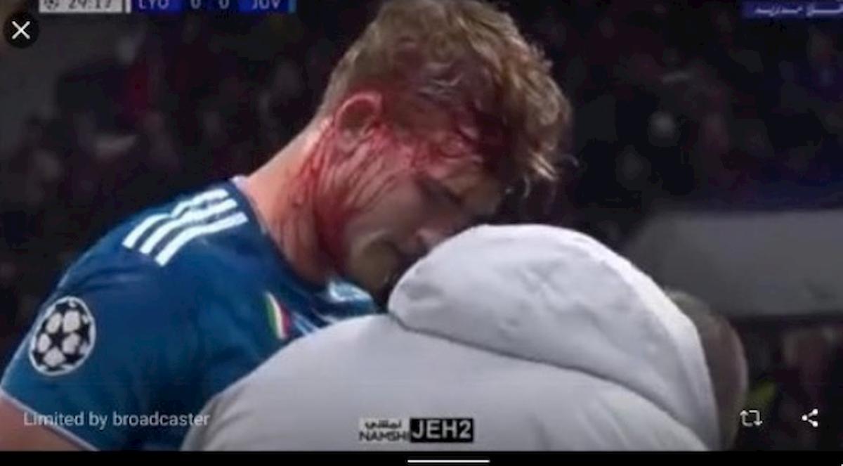 Lione-Juventus, De Ligt: sangue e fasciatura dopo colpo alla testa