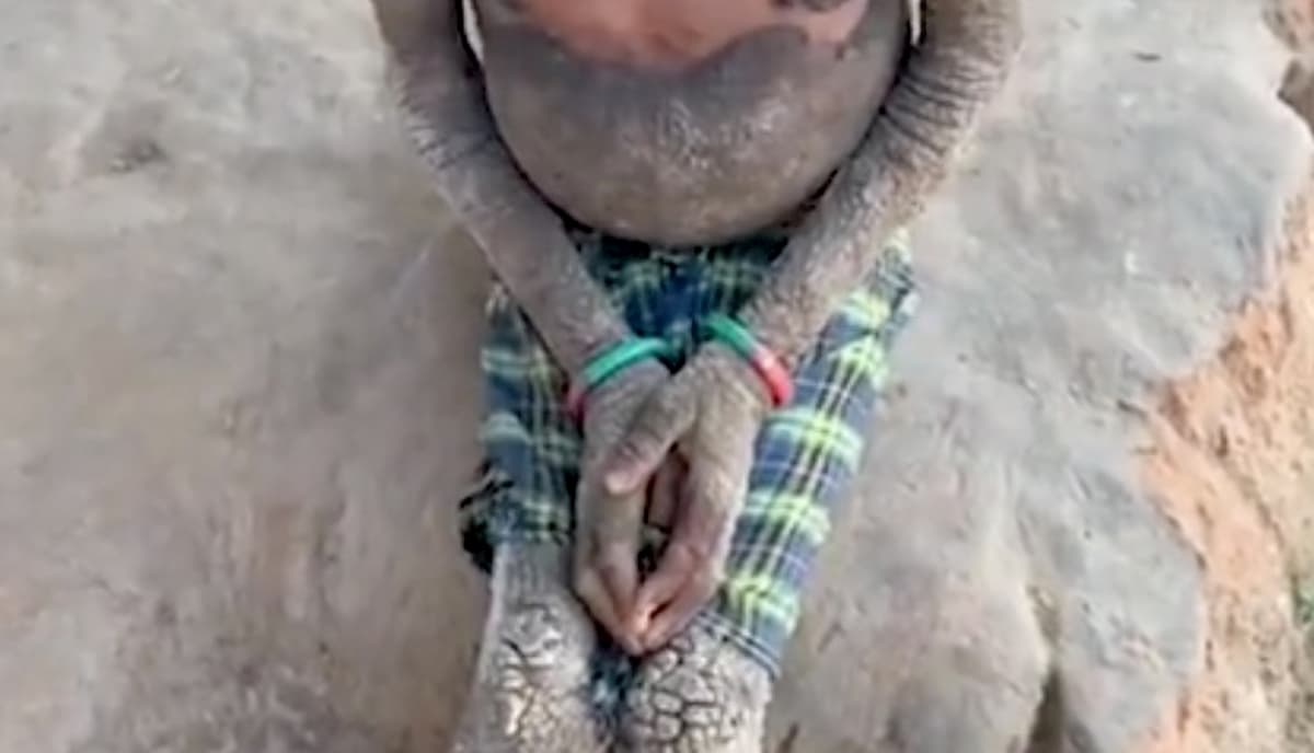 Ittiosi epidermolitica, il caso della bambina indiana con il corpo che si sta "pietrificando"