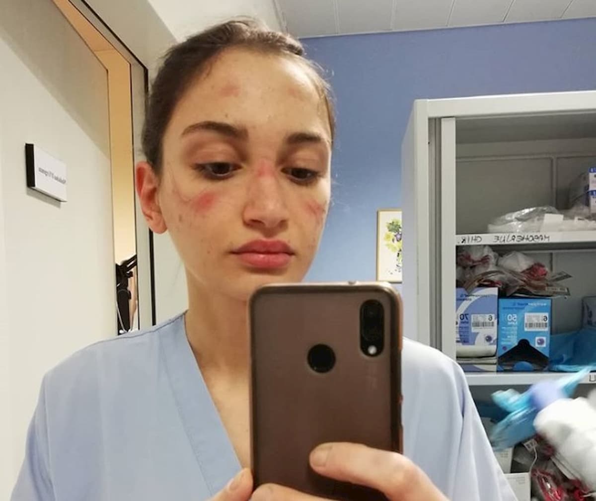 Coronavirus, l’appello dell’infermiera che mostra i lividi della mascherina: "Restate a casa, non vanificate i nostri sforzi"