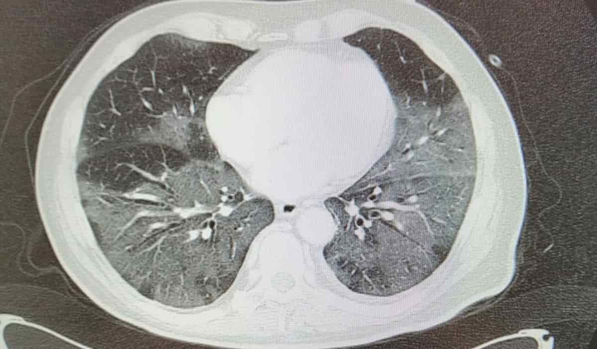 Daniele Macchini, il post Facebook del medico di Bergamo che racconta la "guerra" negli ospedali lombardi