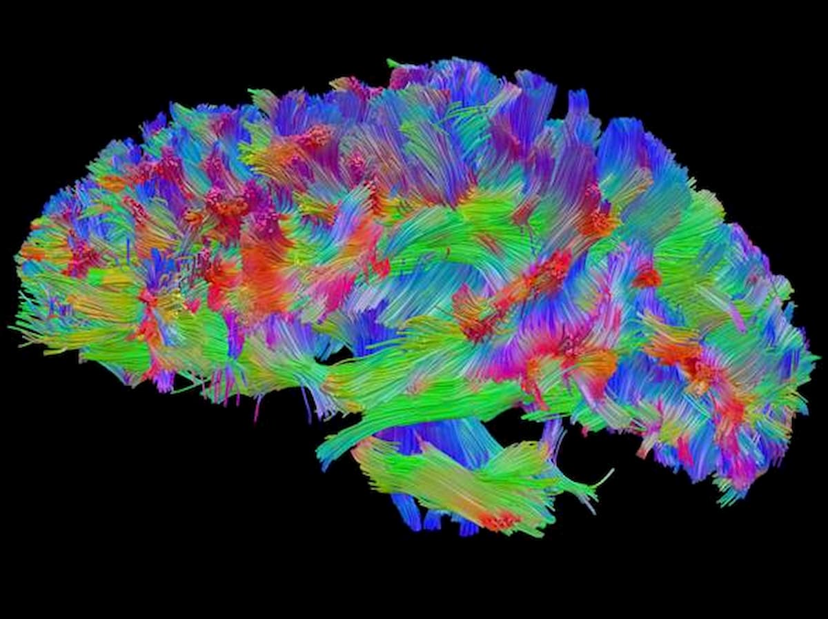 Paralizzato a gambe e braccia, riesce ad usare le mani grazie ad un impianto al cervello
