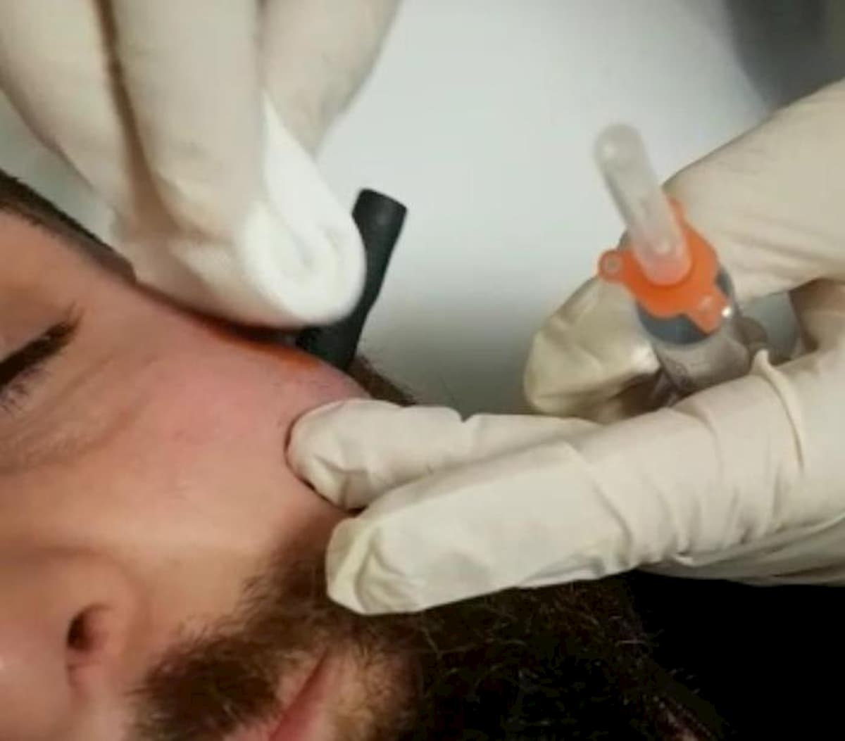 Carceri, agente penitenziario "infilzato" con una penna ad uno zigomo da detenuto