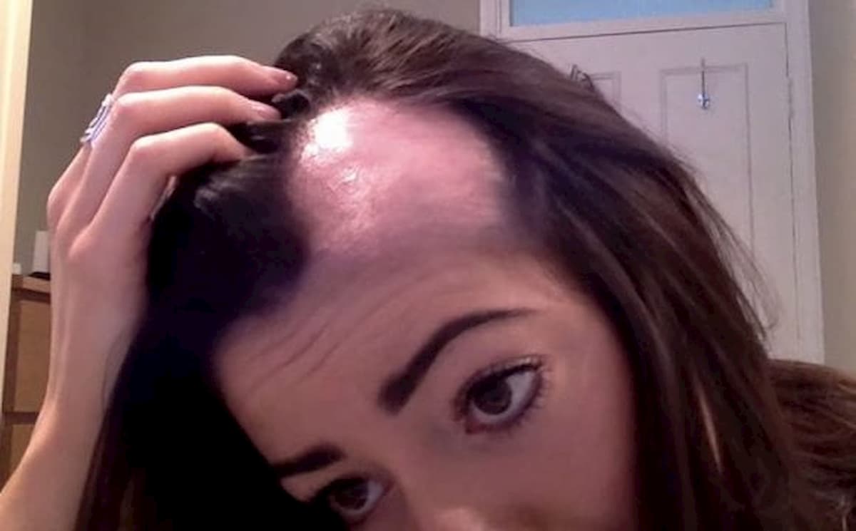 Mangia una passata di zucca e perde tutti i capelli: era intossicazione alimentare causata da un insetto