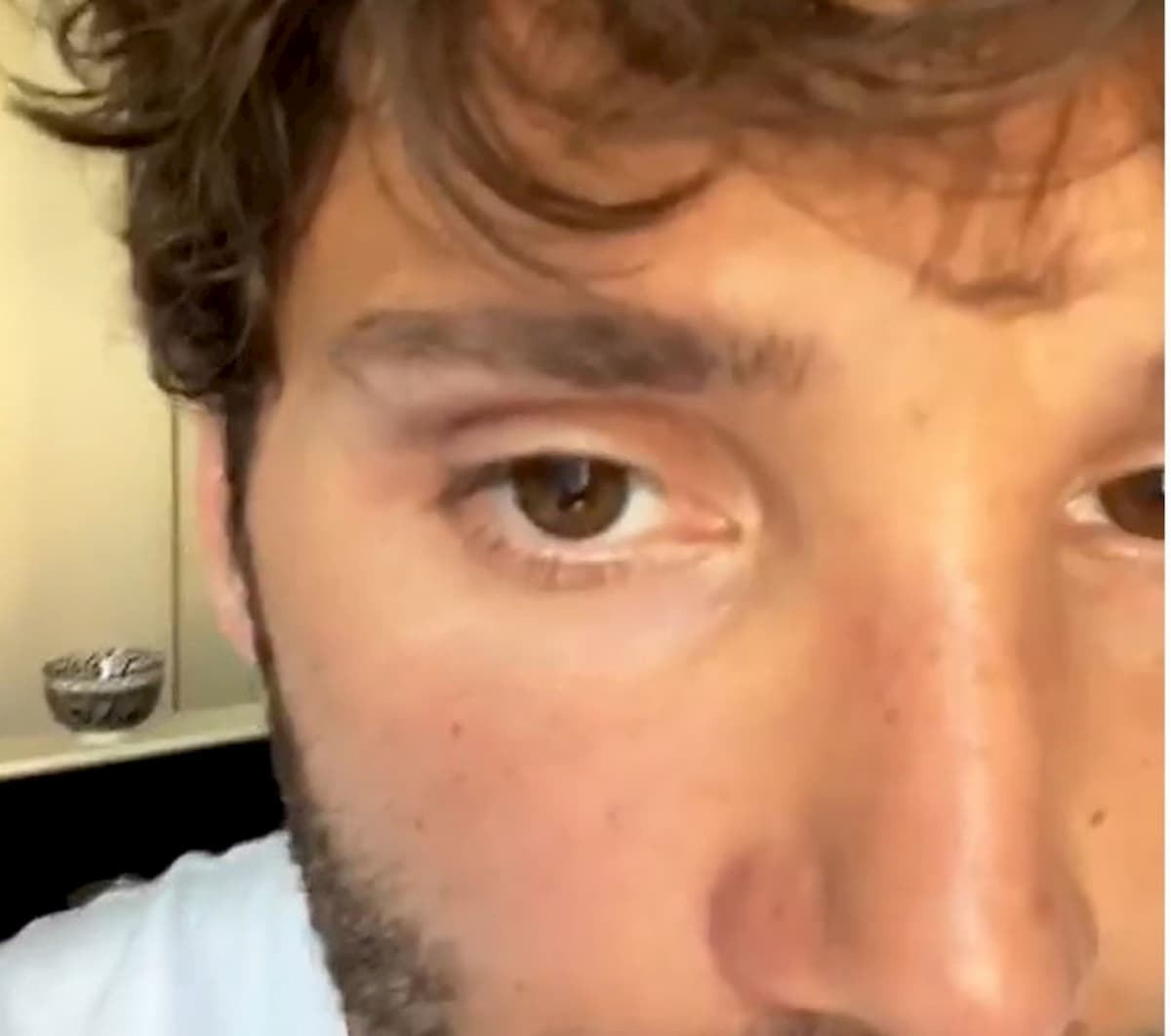 Stefano De Martino con un occhio nero