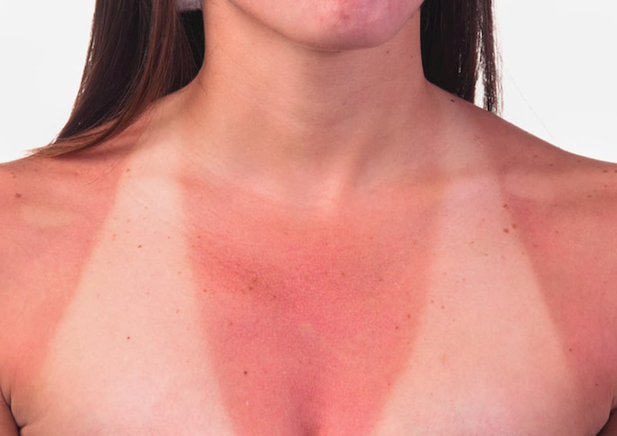 Boom di casi sospetti di tumore della pelle a Napoli