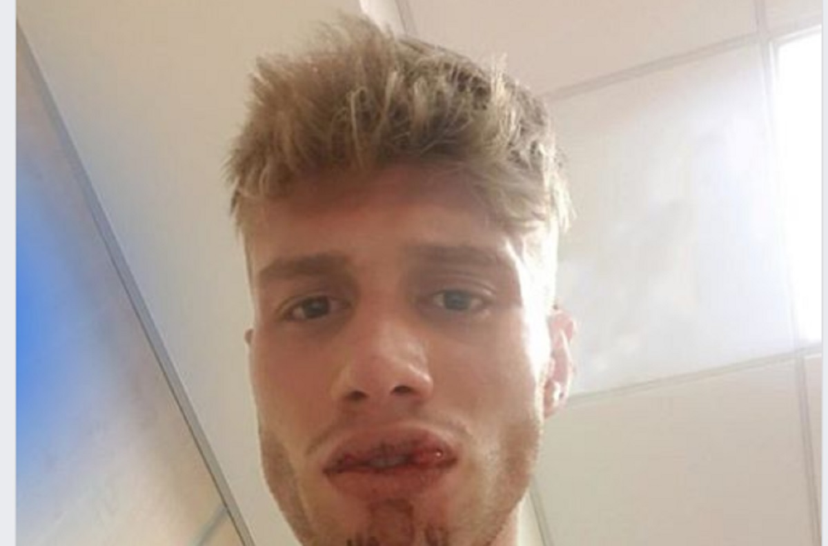 "Un poliziotto in borghese mi ha spaccato il labbro": la denuncia di un ragazzo a Roma