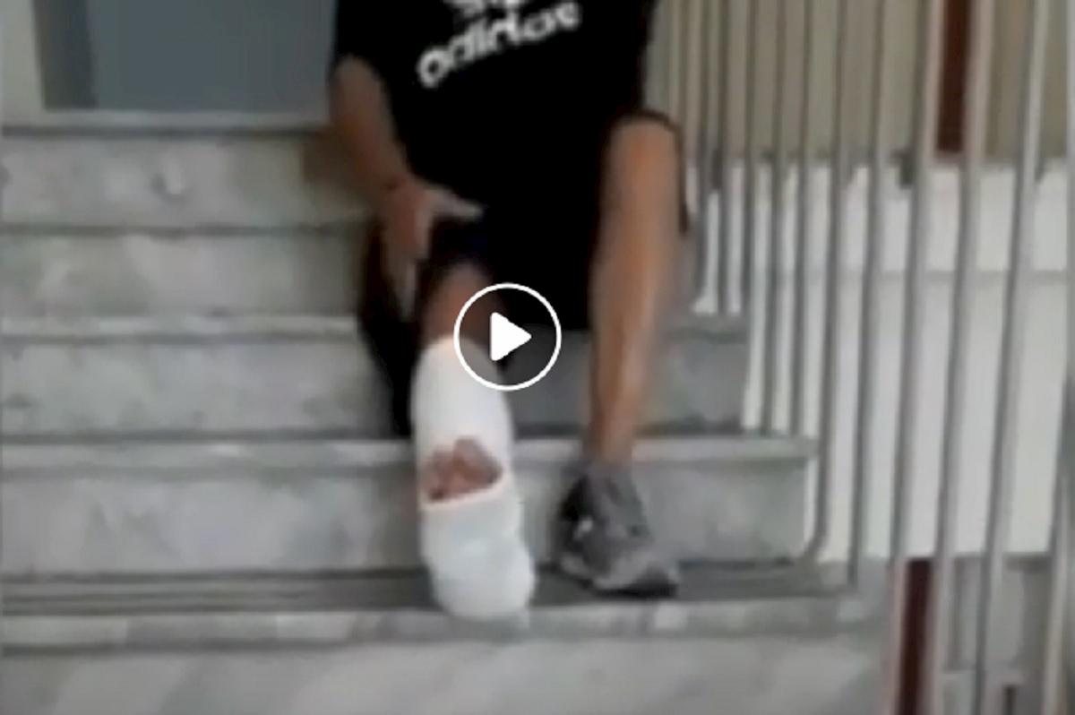 piee rotto, ospedale a Napoli