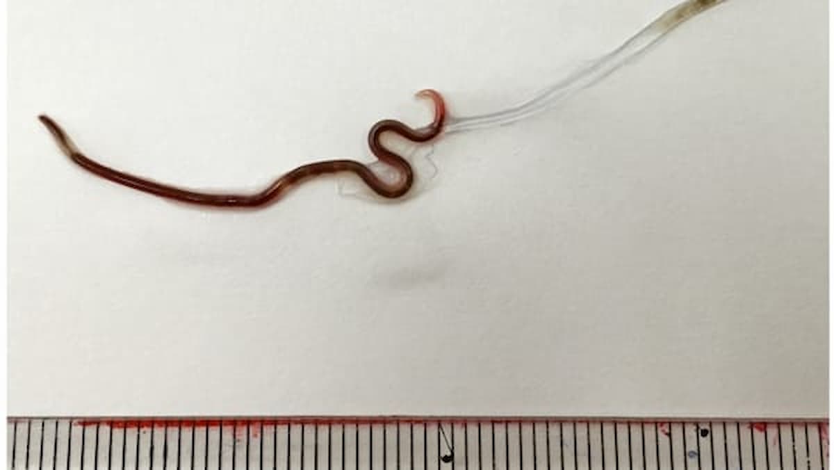 Mangia sashimi e si trova nella gola verme di 4 centimetri