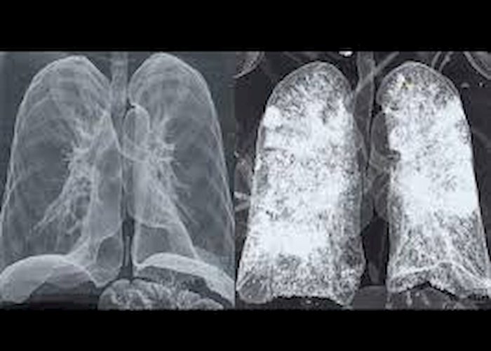 Coronavirus, Gianluigi Nuzzi pubblica Tac polmoni: "Foto da mostrare a chi fa ancora il pirla"