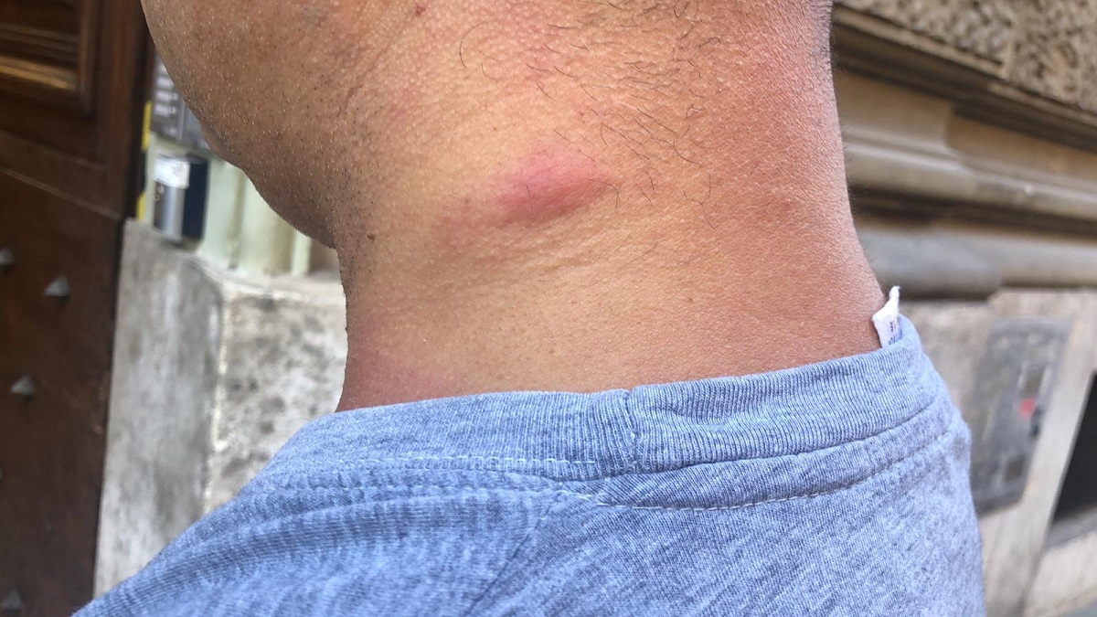 Una puntura di zanzara