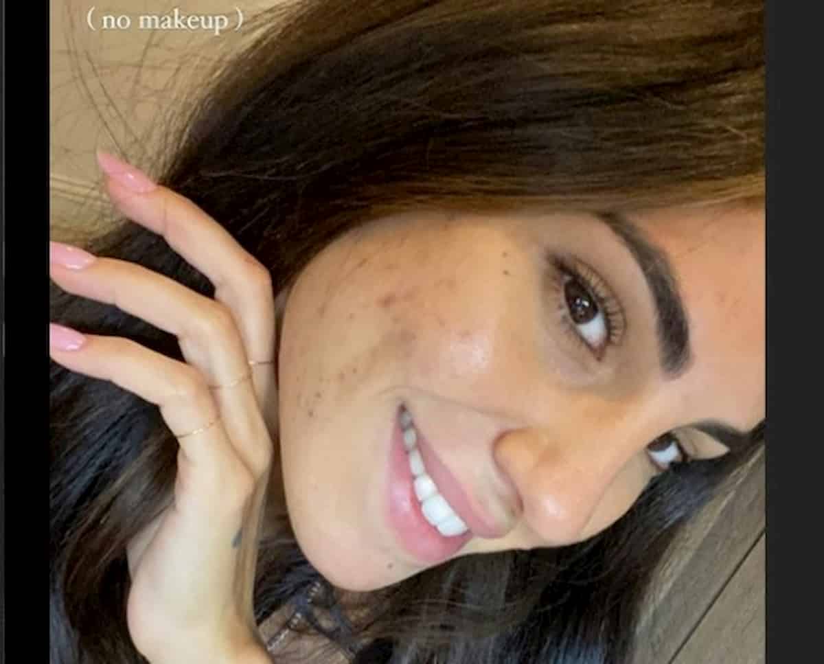 Giulia De Lellis mostra l'acne su Instagram