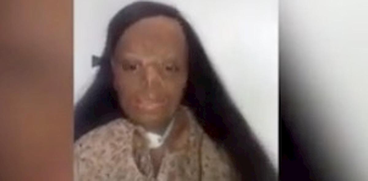 Aleema Ali: sfigurata da uno shampoo per pidocchi che ha preso fuoco, si sveglia dal coma e diventa star di Tik Tok