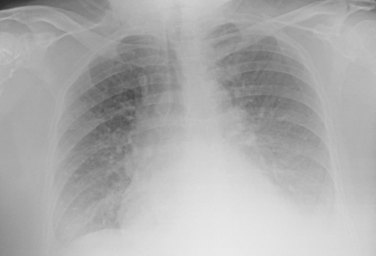 Covid, ecografia polmonare meglio del tampone per scovarlo. E che facciamo, i drive in coi raggi X? Lo studio delle Molinette