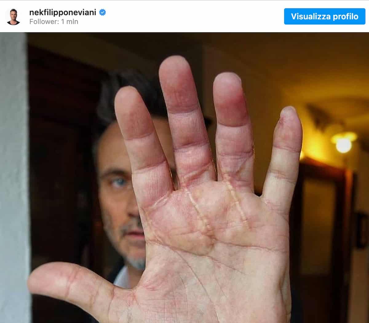 Nek, cosa ha fatto alla mano: la foto con la cicatrice dopo l'incidente con la sega circolare