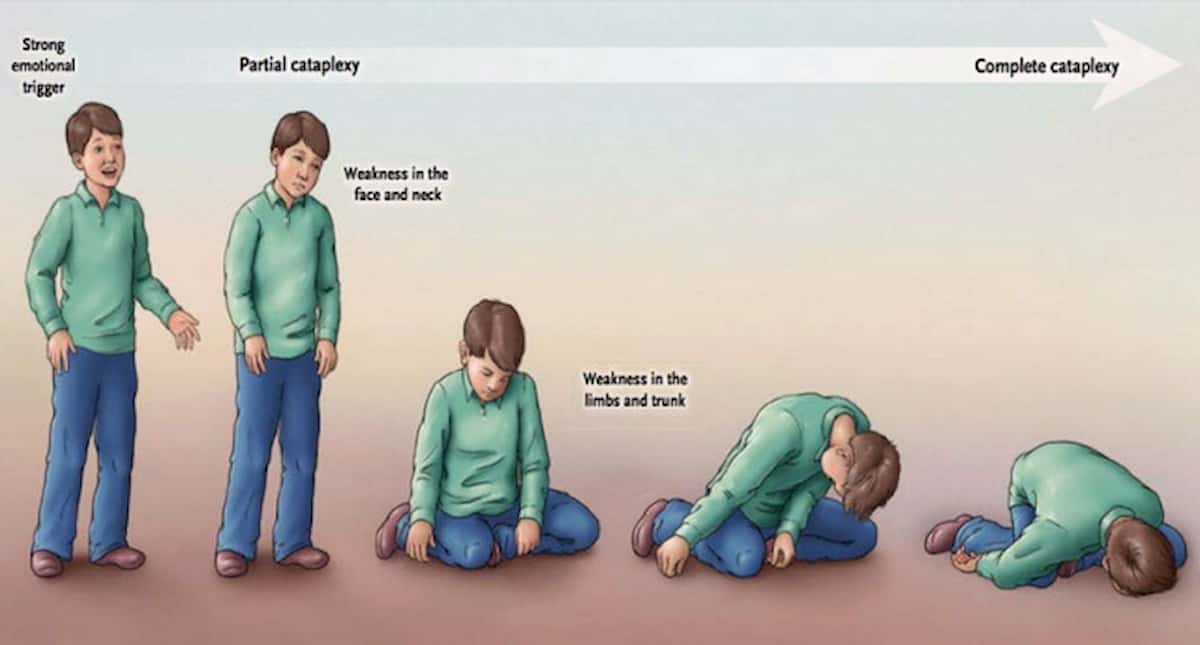 La mamma che non può ridere, piangere perché soffre di cataplessia