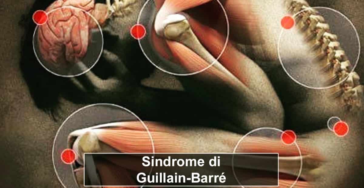 Vaccino AstraZene sindrome Guillain-Barré