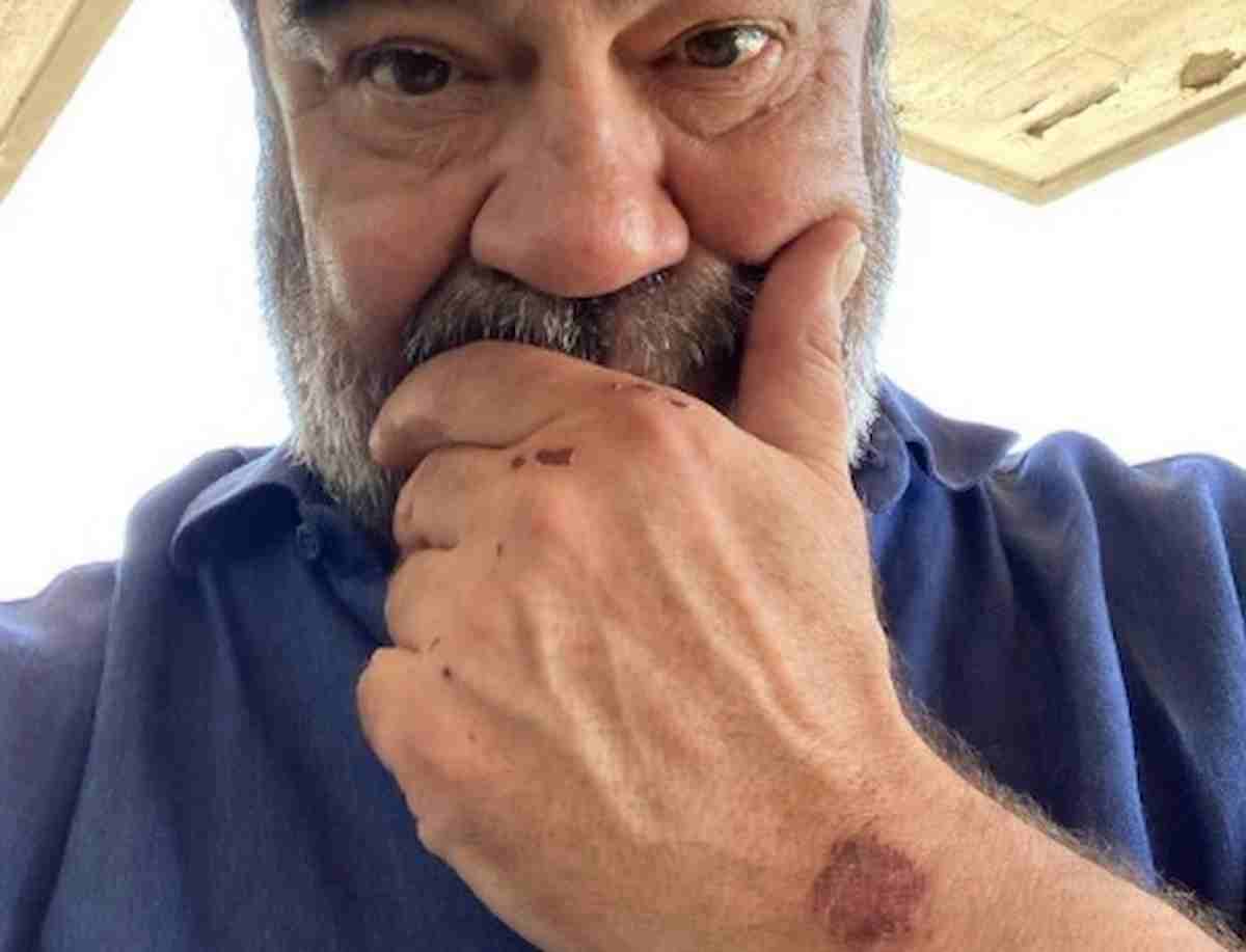 Francesco Pannofino, incidente in moto: "Brutta botta ma sto bene". La foto su Instagram con le ferite