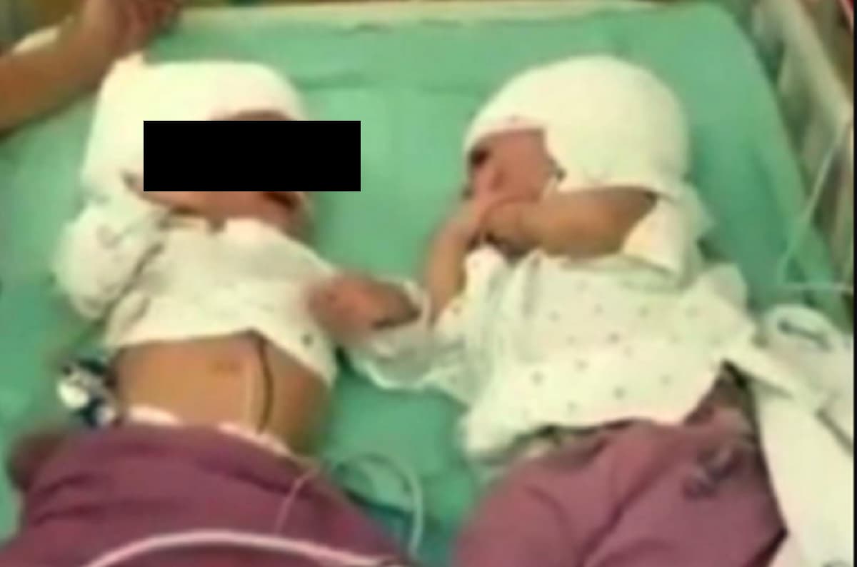 Gemelline siamesi attaccate dietro la testa si guardano per la prima volta dopo l'intervento FOTO