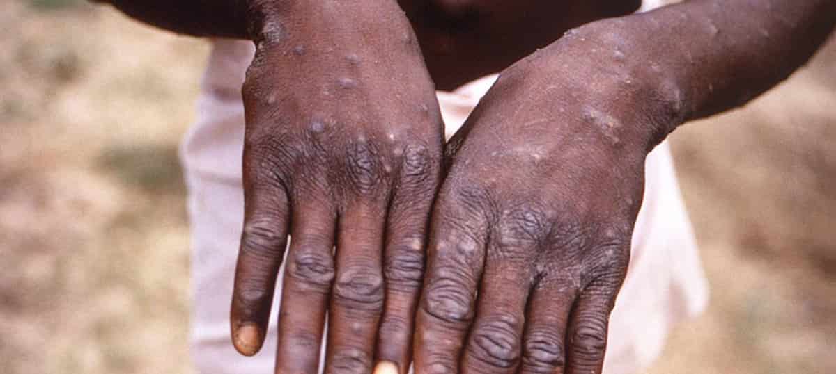 Vaiolo delle scimmie, il virus può essere nel liquido seminale: la scoperta dello Spallanzani
