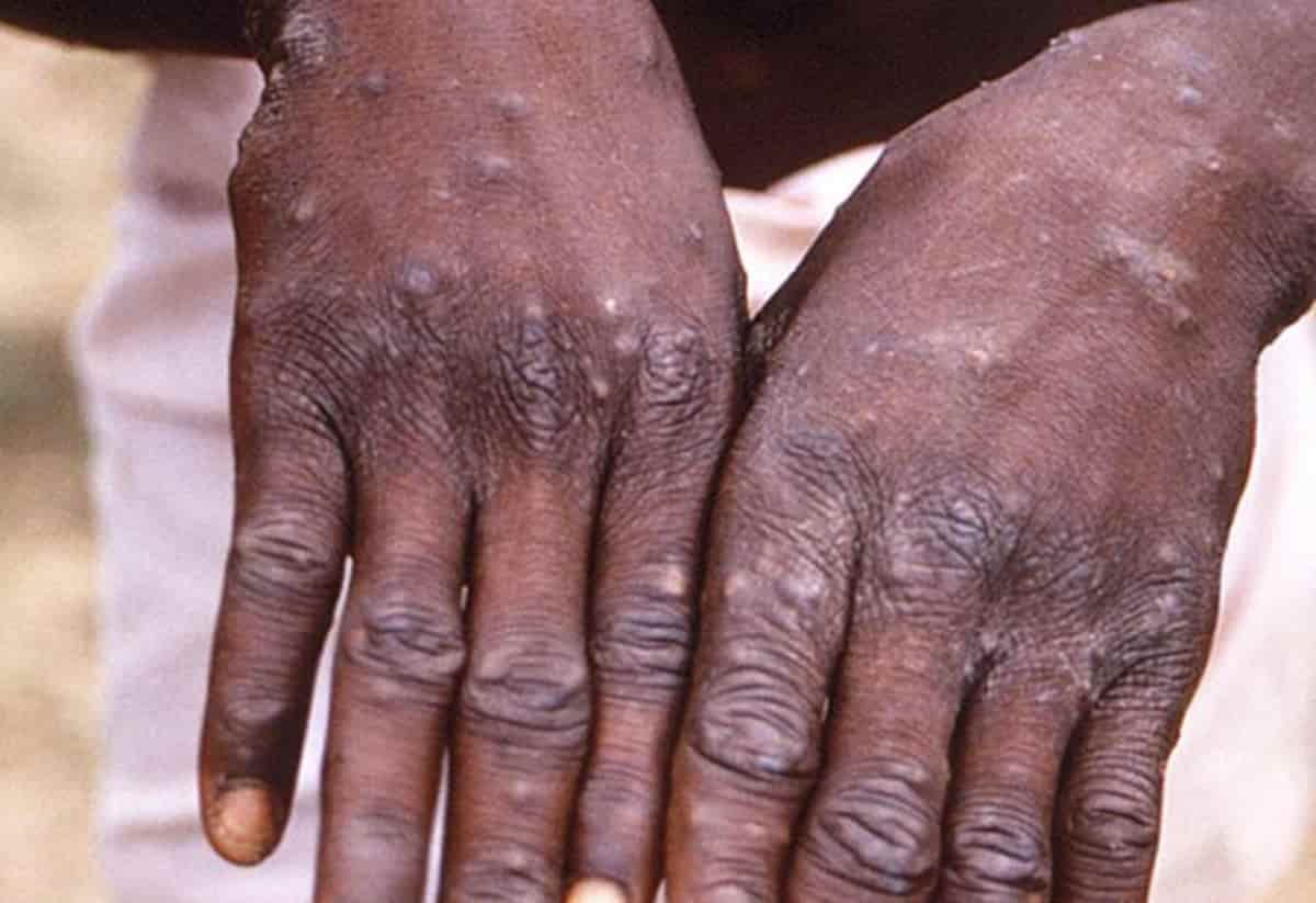 Vaiolo delle scimmie, in Europa +50% casi in una settimana. Lunghe file a NY per vaccinarsi